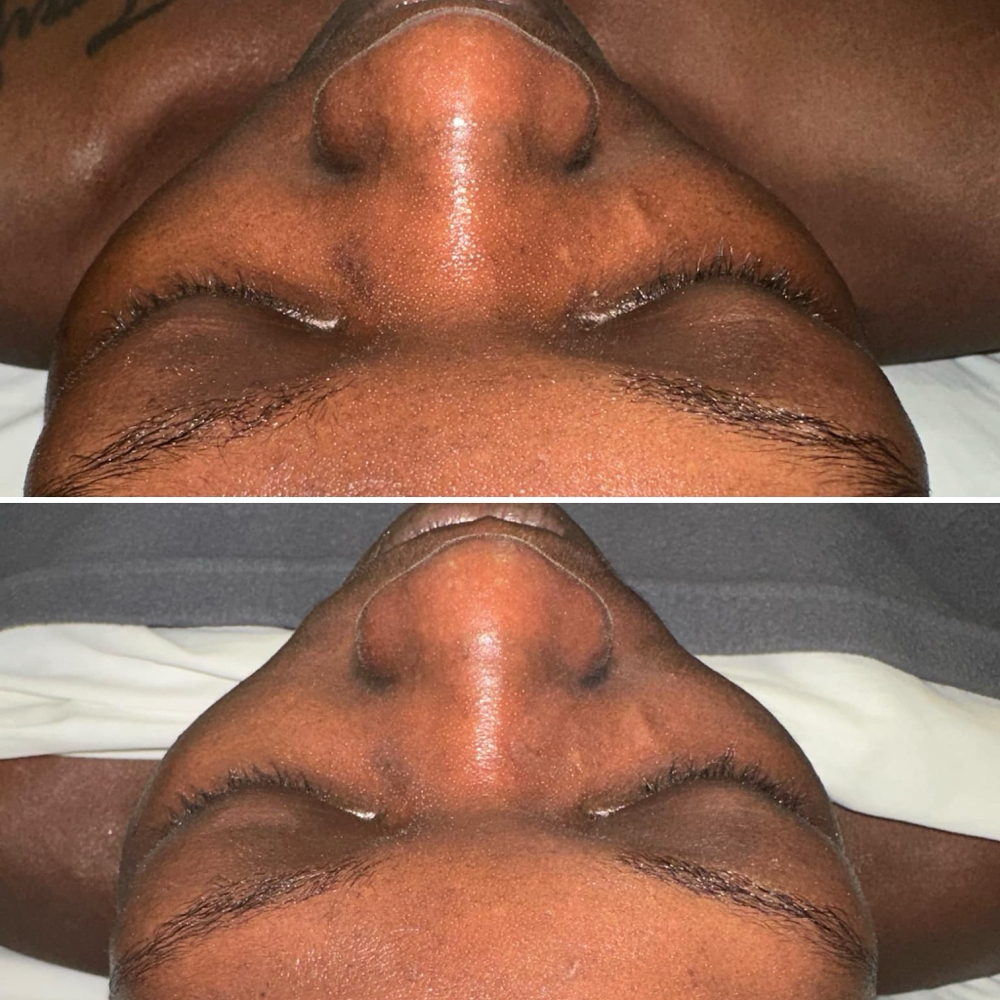 Chemical peel