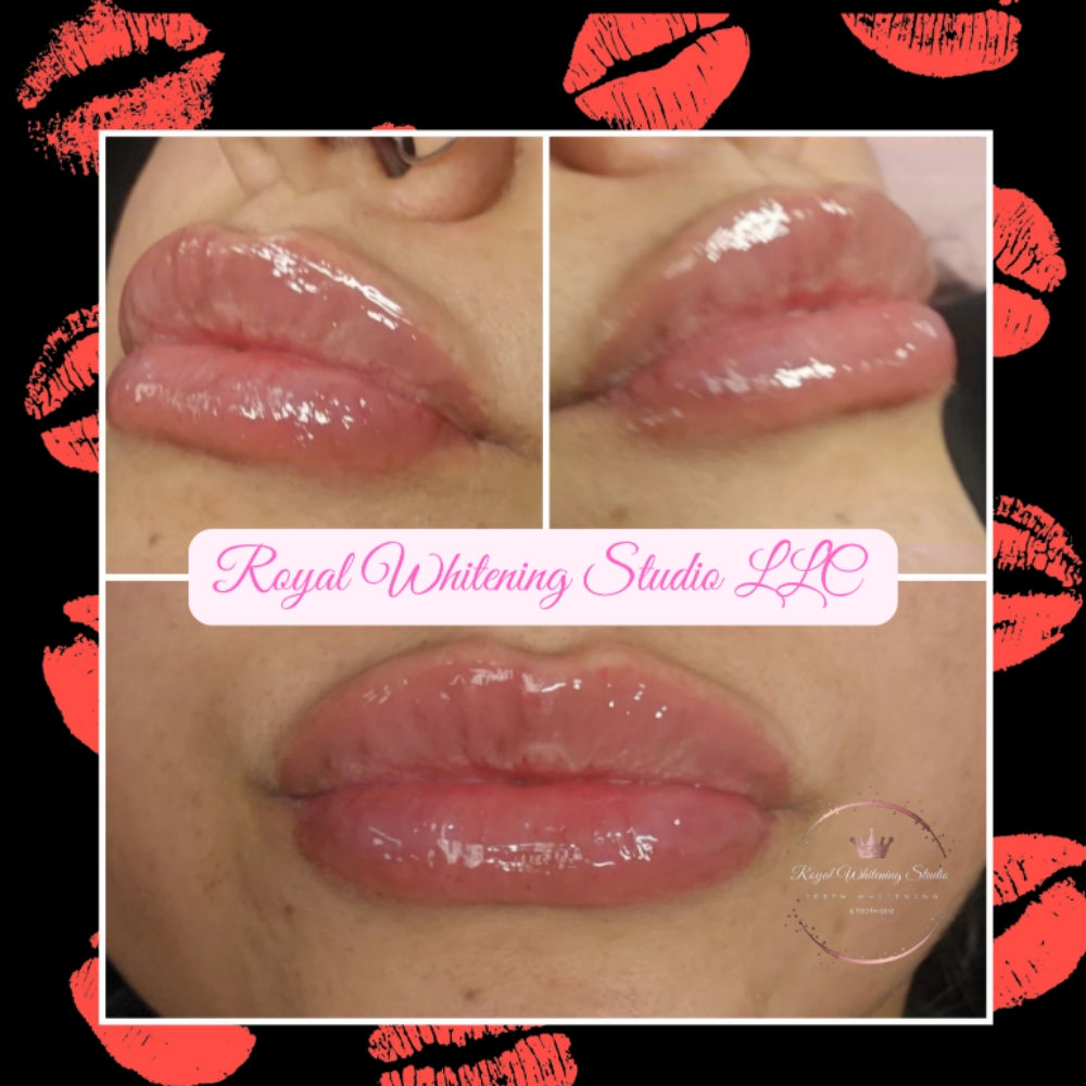 1ML Needle-less Lip Filler at Royal Whitening Studio LLC in Copperas Cove, TX