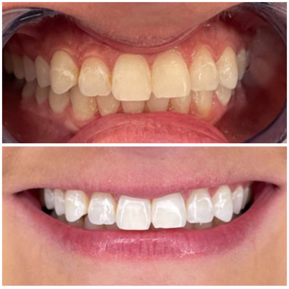 30 Minute Teeth Whitening