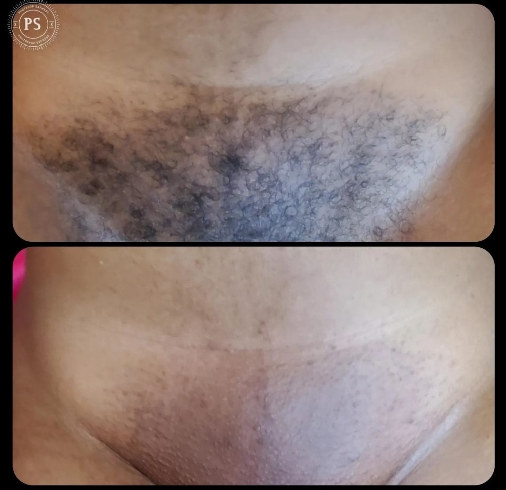 Brazillian/Manzilian Waxing