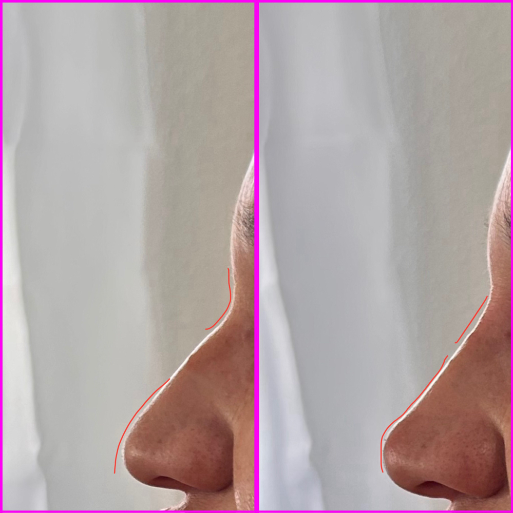 Liquid Rhinoplasty