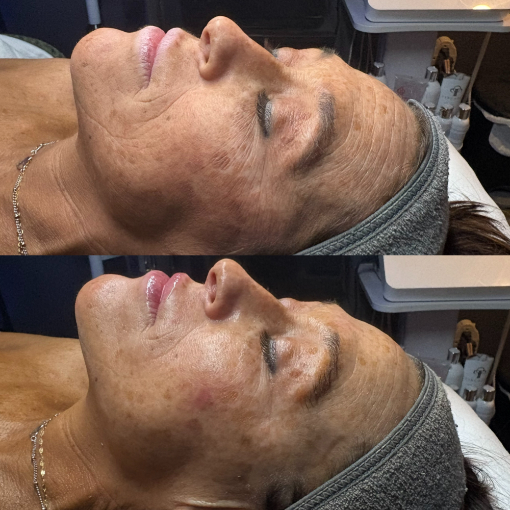 The Elite Facial (3 Upgrades) at Hallie Caitlyn Aesthetics in Pineville, KY
