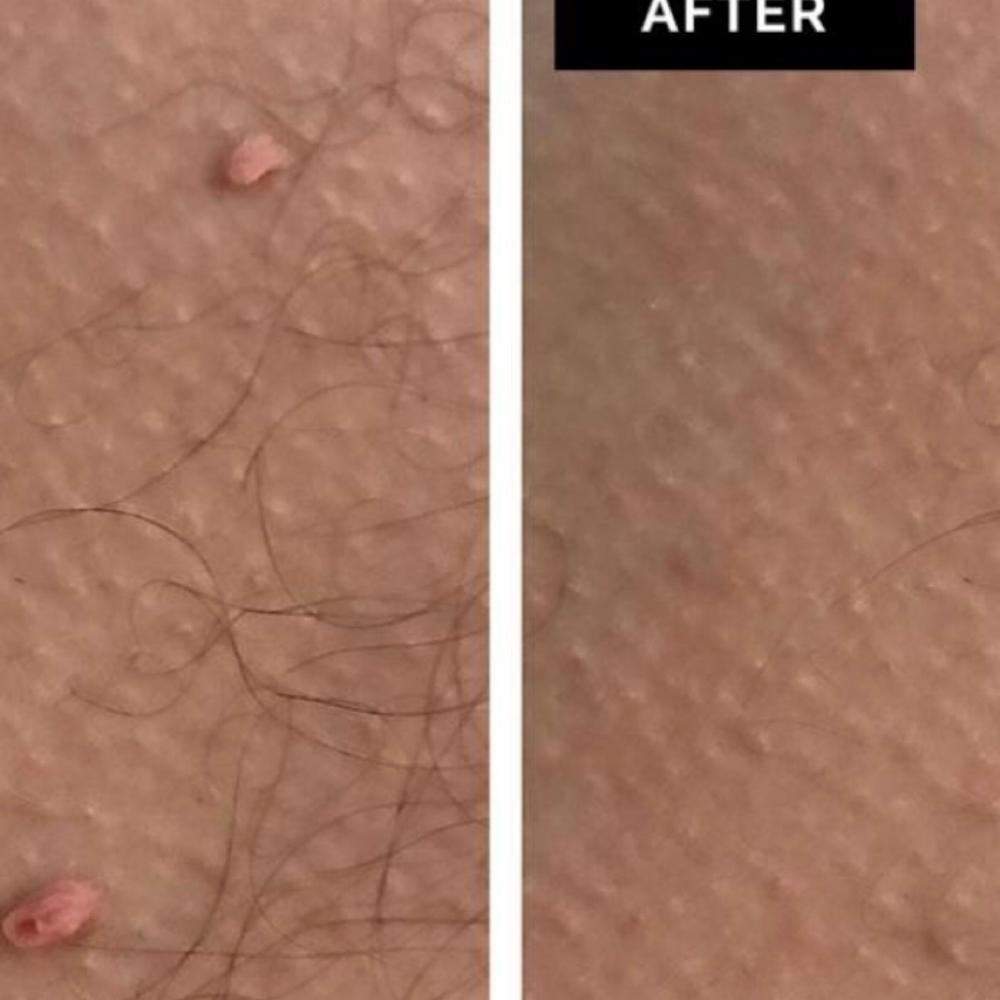 Skin Classic Thermolysis Treatment at Beyond Beauty & Glow in Lincolnshire, IL