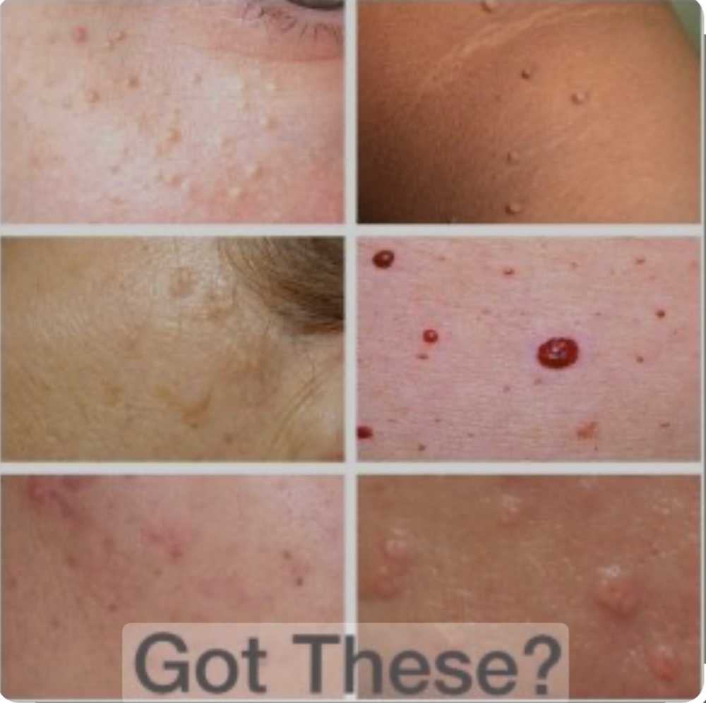 Skin Classic Thermolysis Treatment