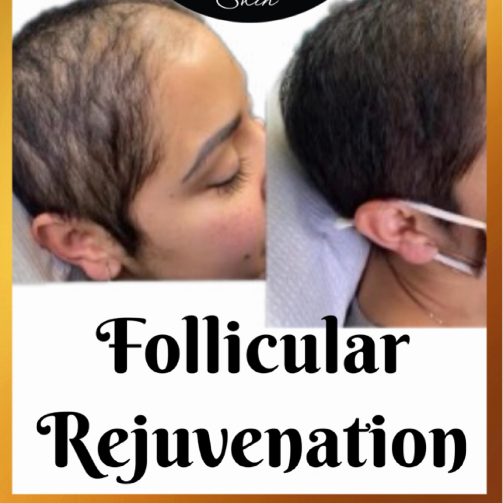 Consultation/Microscopic Scope with Advanced Hairloss Treatment at Potent Transitions in East Orange, NJ