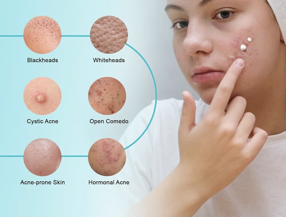 Facial Introductorio para Acné