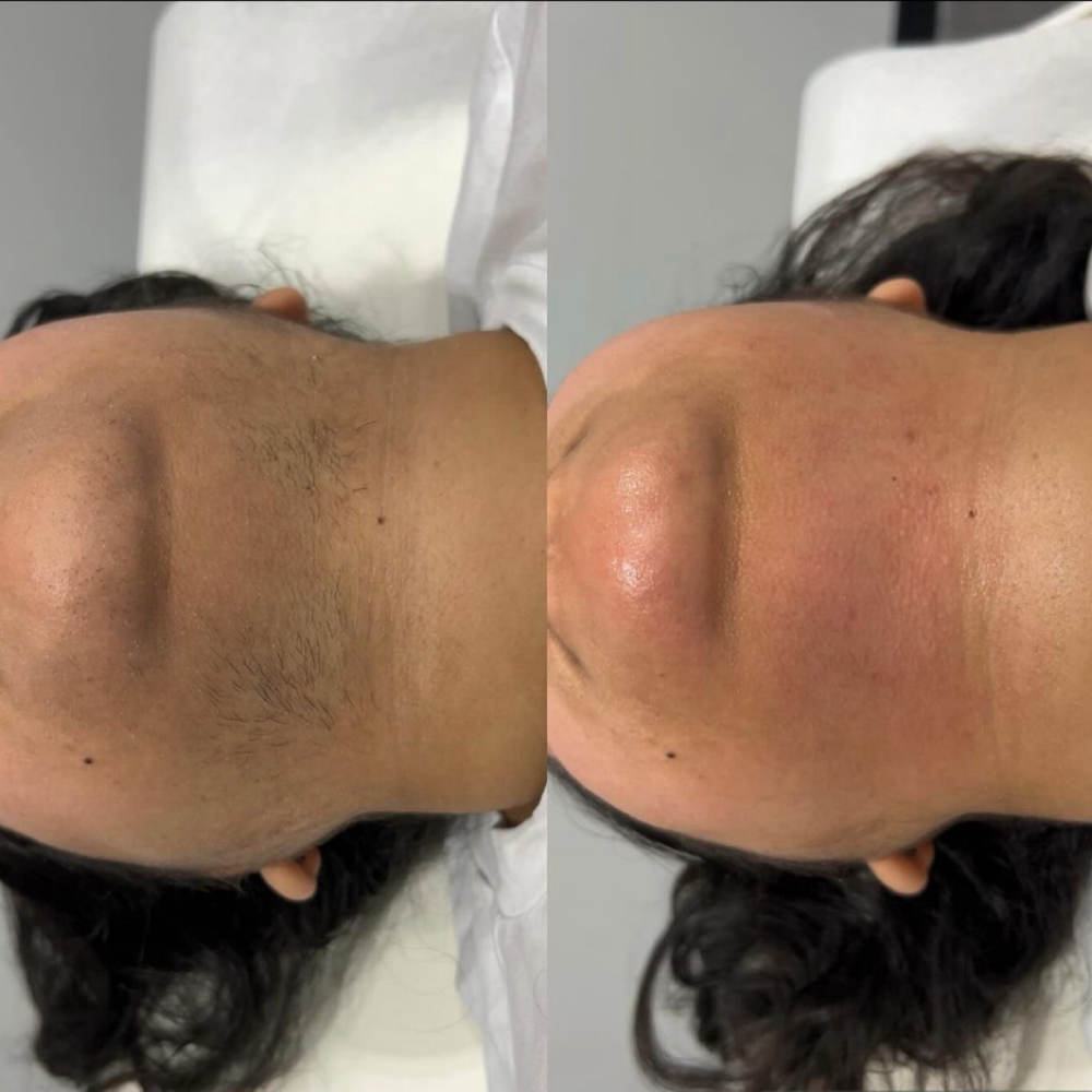 Chin Wax at You Glow Girl Esthetics in Roscoe, IL