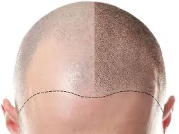Scalp Micropigmentation (Price TBD) at ACQUA + Ink in Springdale, AR