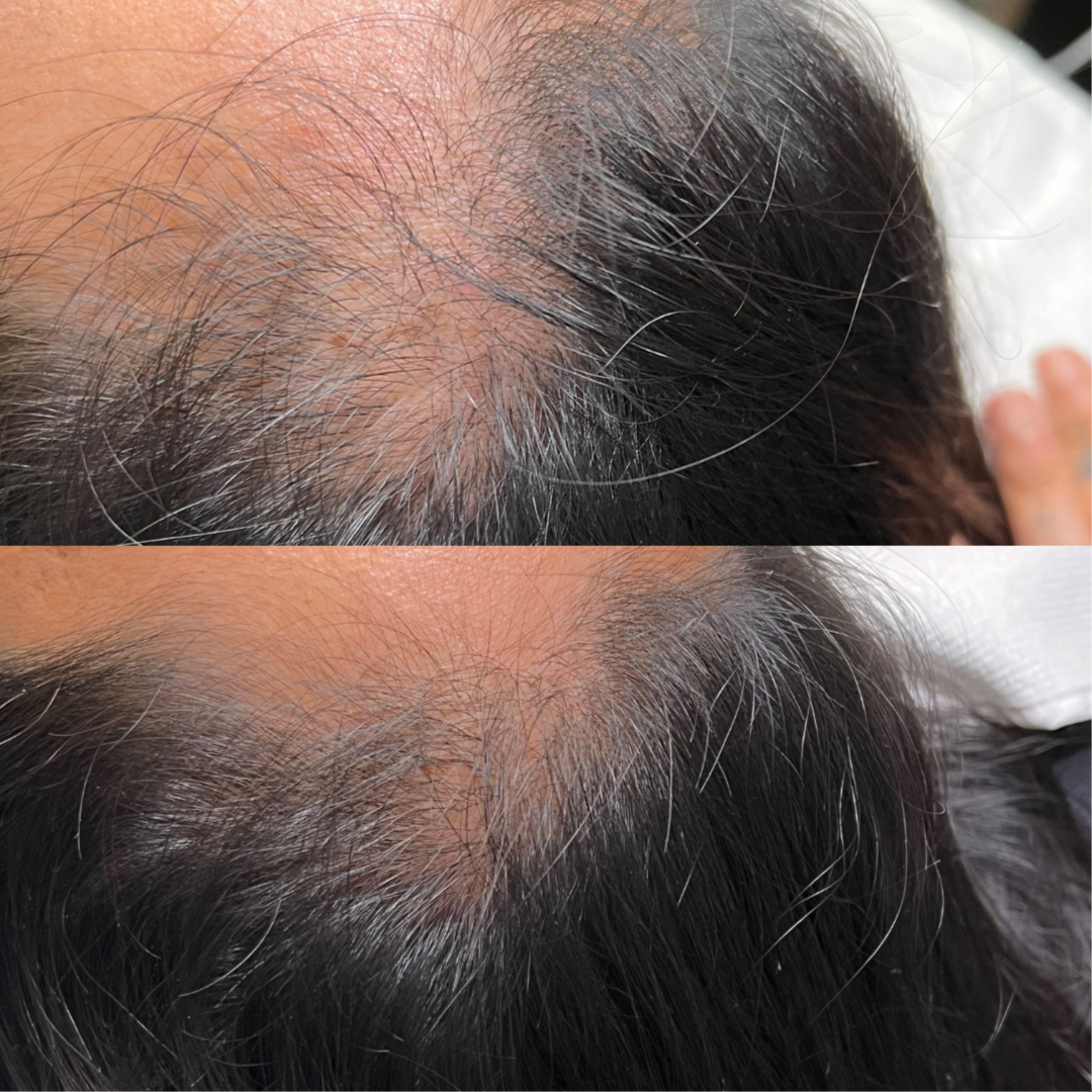 HydraScalp Treatment with Keravive at 7esthetics Skin Studio in Lewisville, TX