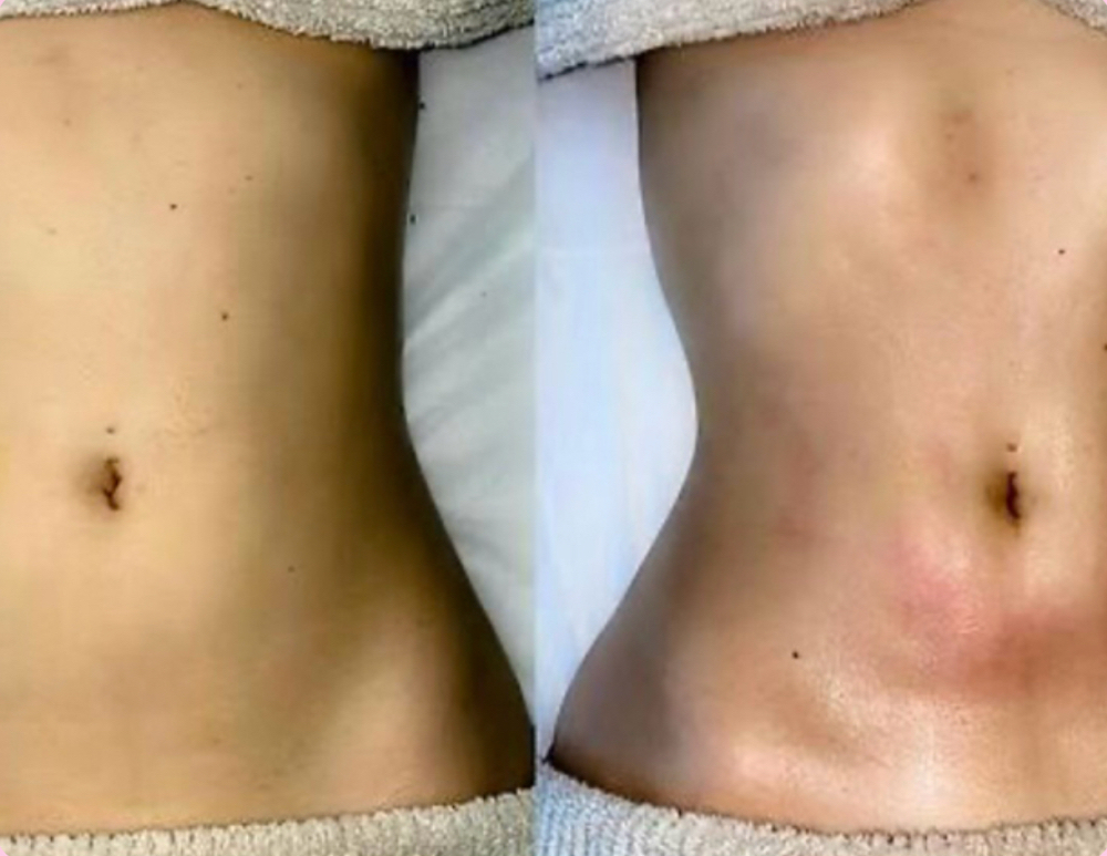 PRE-OP LYMPHATIC DRAINAGE at Nishati Wellness in Kennewick, WA