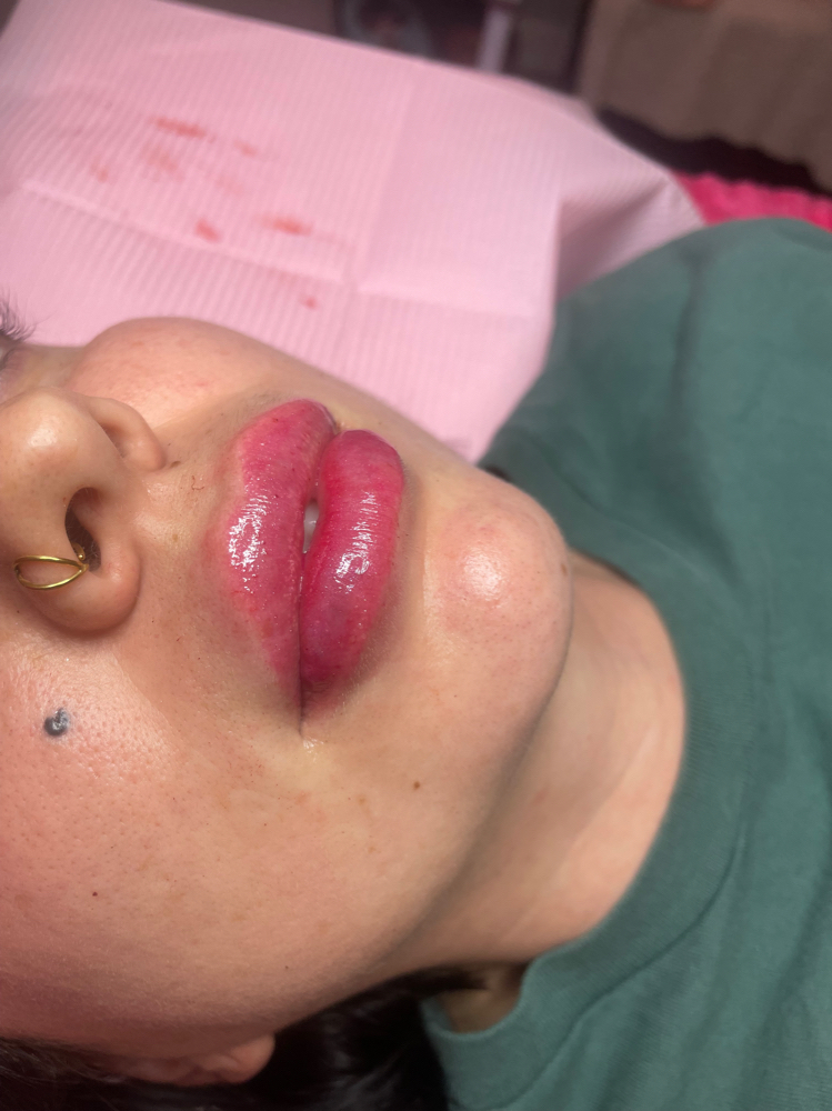 2mls Of Lip Filler.