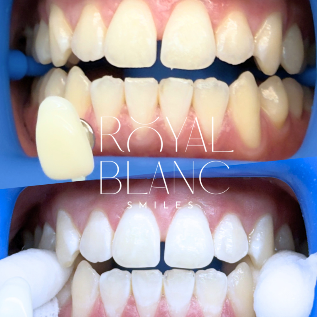 Touch-Up Session at Royal Blanc Smiles - Teeth Whitening and Tooth Gems in Charlotte, NC in Charlotte, NC