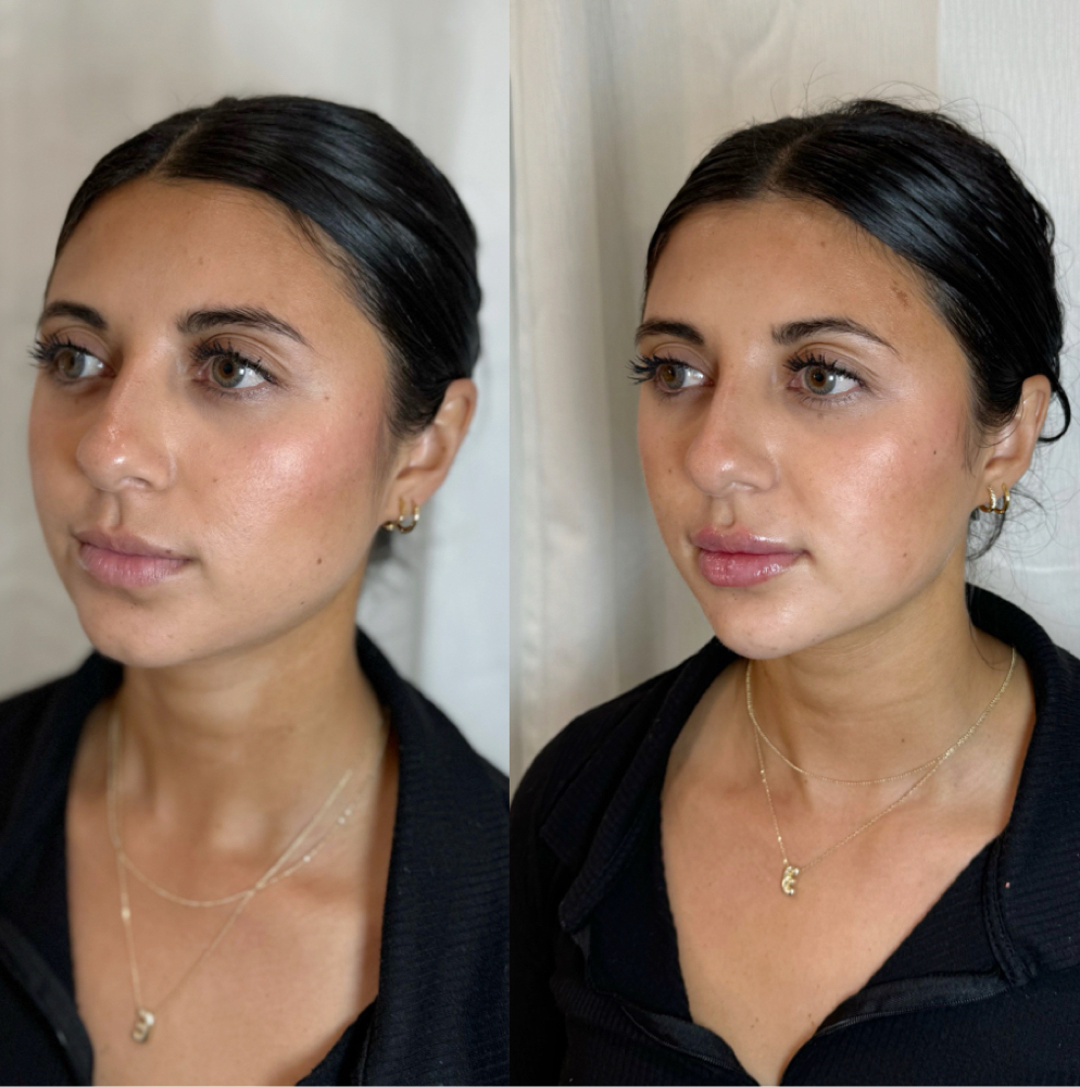 Sculptra® at Lace Skn in West Lake Hills, TX