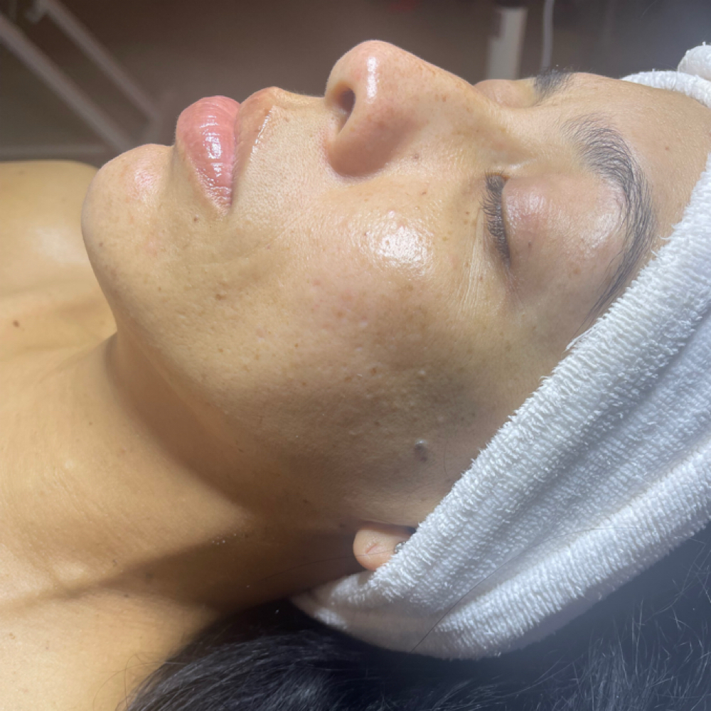 Ventuno Custom with Chemical Peel at Ventuno Per Sempre in Fitchburg, MA