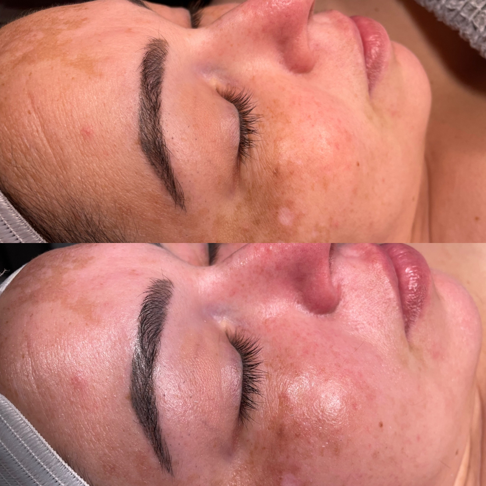 Classic Facial W/ Extraction