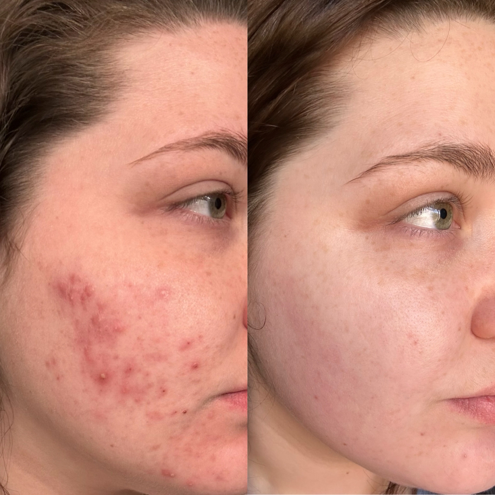 Acne Consultation + Treatment at Glaze Aesthetics in Las Vegas, NV
