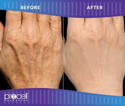 Procell Hands Treatment