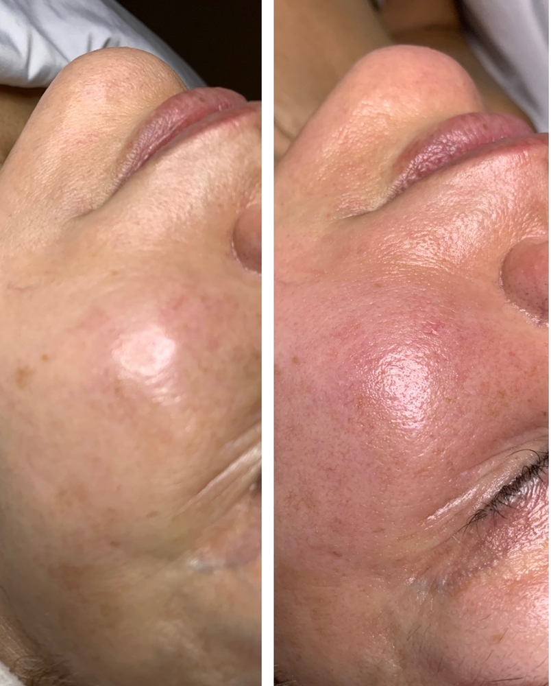 Microneedling with RF Face& Neck