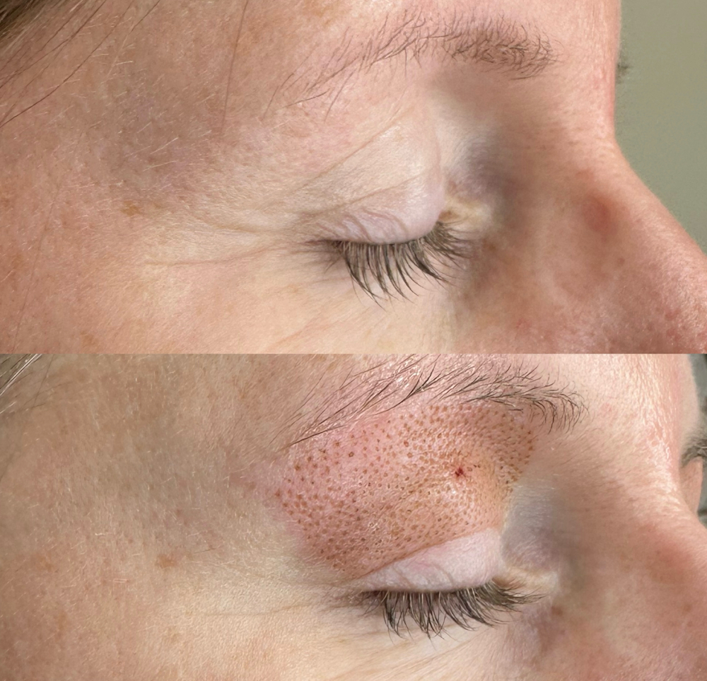 Upper Eyelids (2session Package)