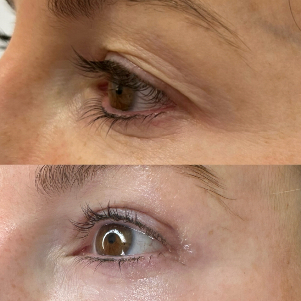 Upper Eyelids (2session Package) at Magnolia Plasma Fibroblasting By Mitra in Frisco, TX