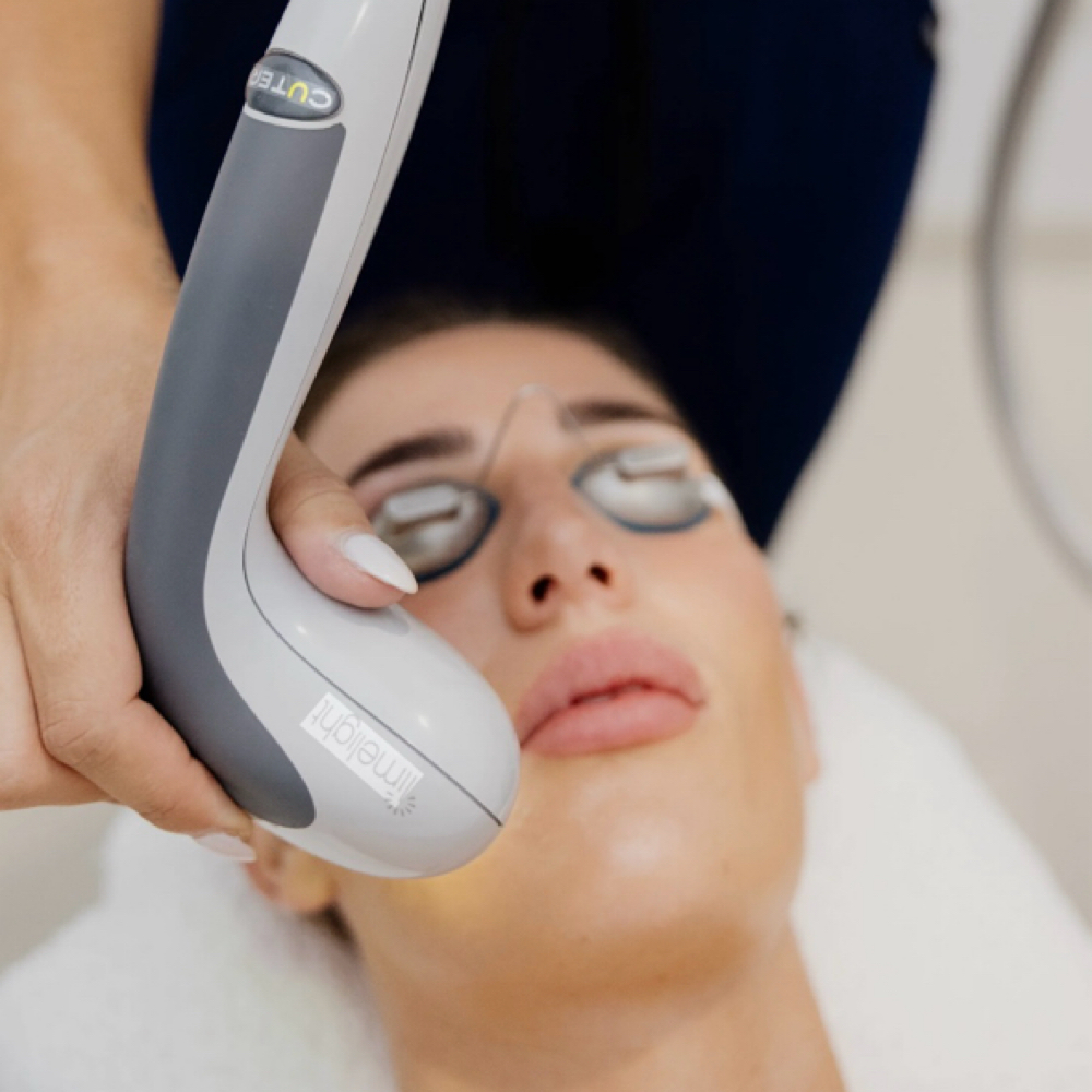 IPL (photofacial) Package Of 3 at Lyfe Aesthetics & Medspa in Indianapolis, IN