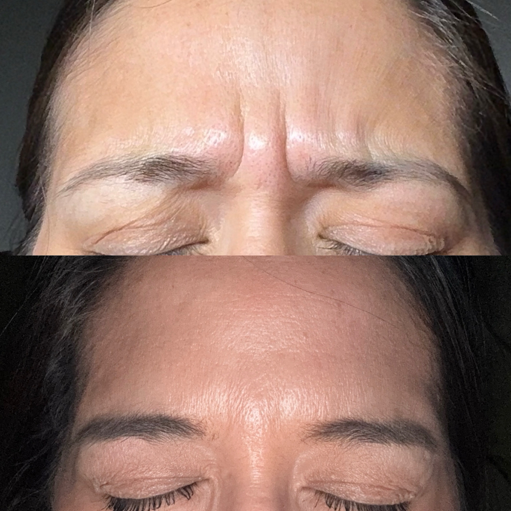 Tox- DAXXIFY Glabella (11’s)