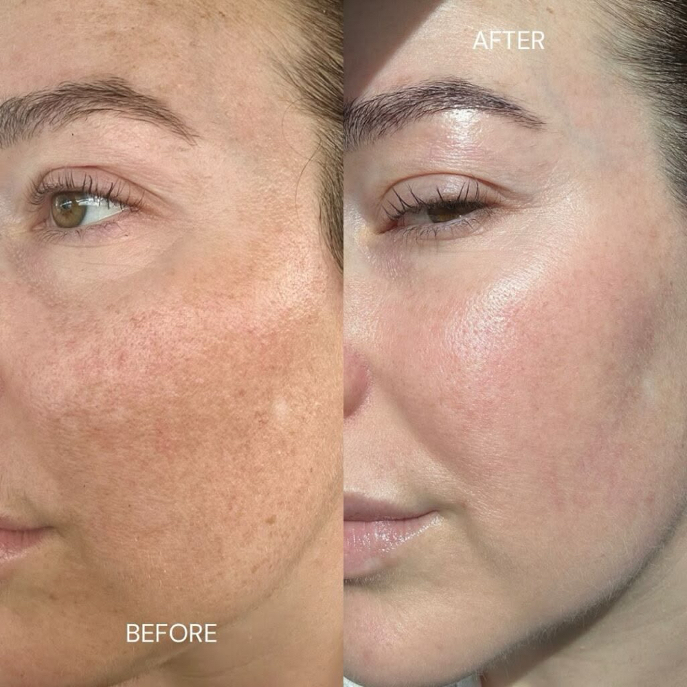 Microneedling at Made New Aesthetics in Lone Tree, CO