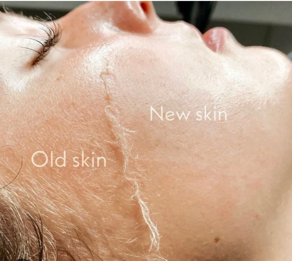 Dermaplane Facial