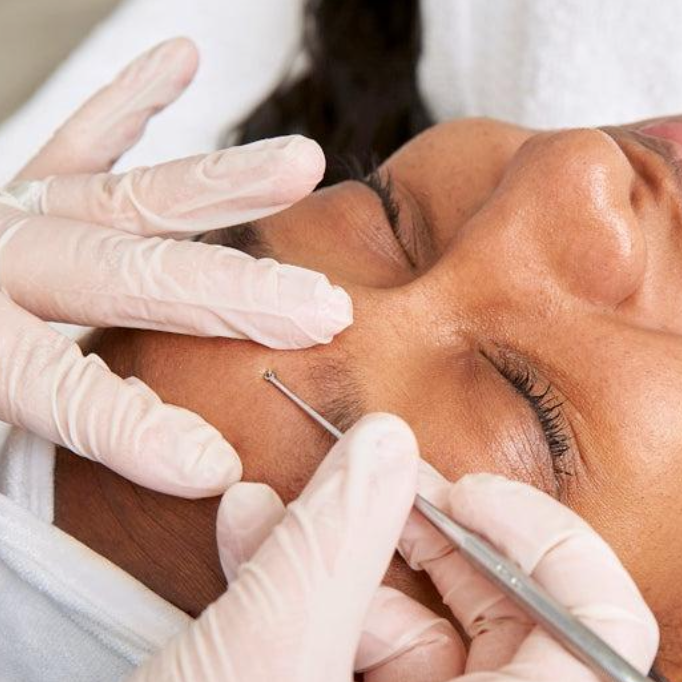 Clarifying Peel + Extractions at Aesthetics by Aunnie in Costa Mesa, CA