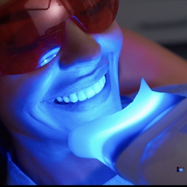 30 Minute Teeth Whitening Session
