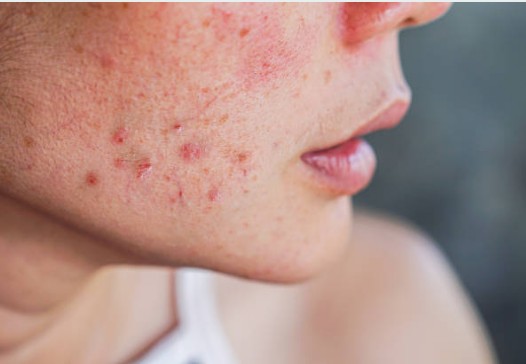 Acne treatment