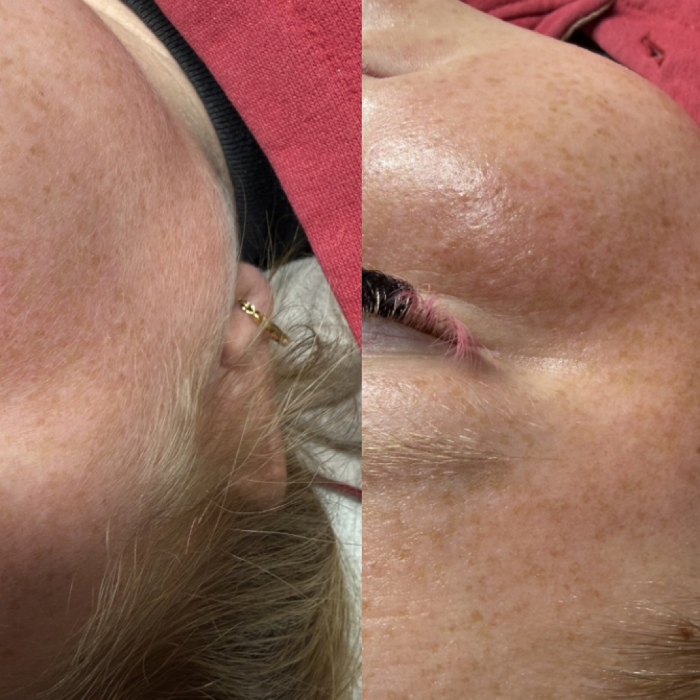 Basic DERMAPLANE at J’s Esthetics in Elkhart, IN