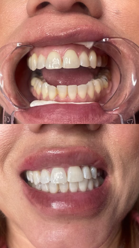 90 Min Teeth Whitening