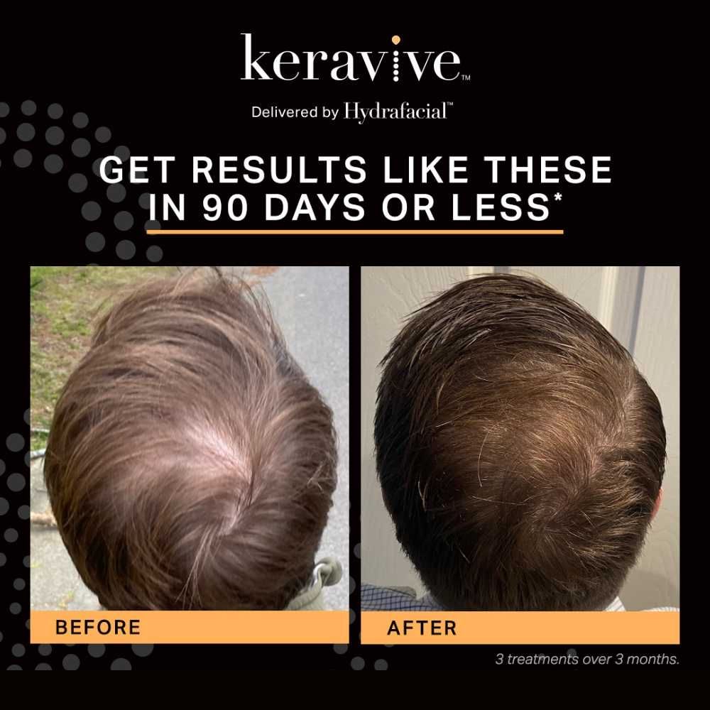 Keravive Scalp Facial