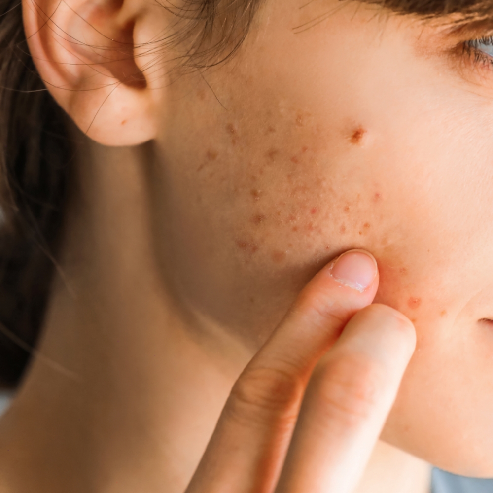 Acne Bootcamp Bi Weekly Tx at R&R Skin and Lash Studio in Sparta, NJ