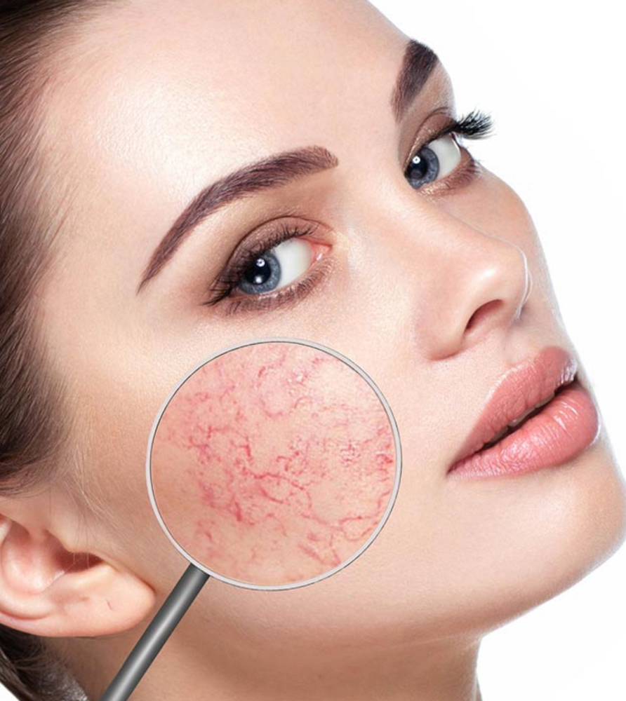 Capillary Reduction treatment