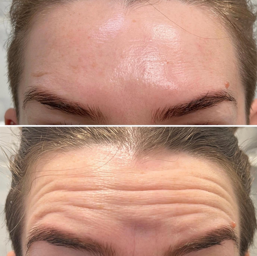Forehead Treatment at Bliss Beauty Bar in Houston, TX