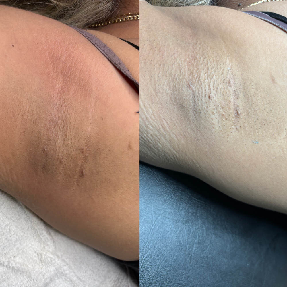 Underarm Treamtnet