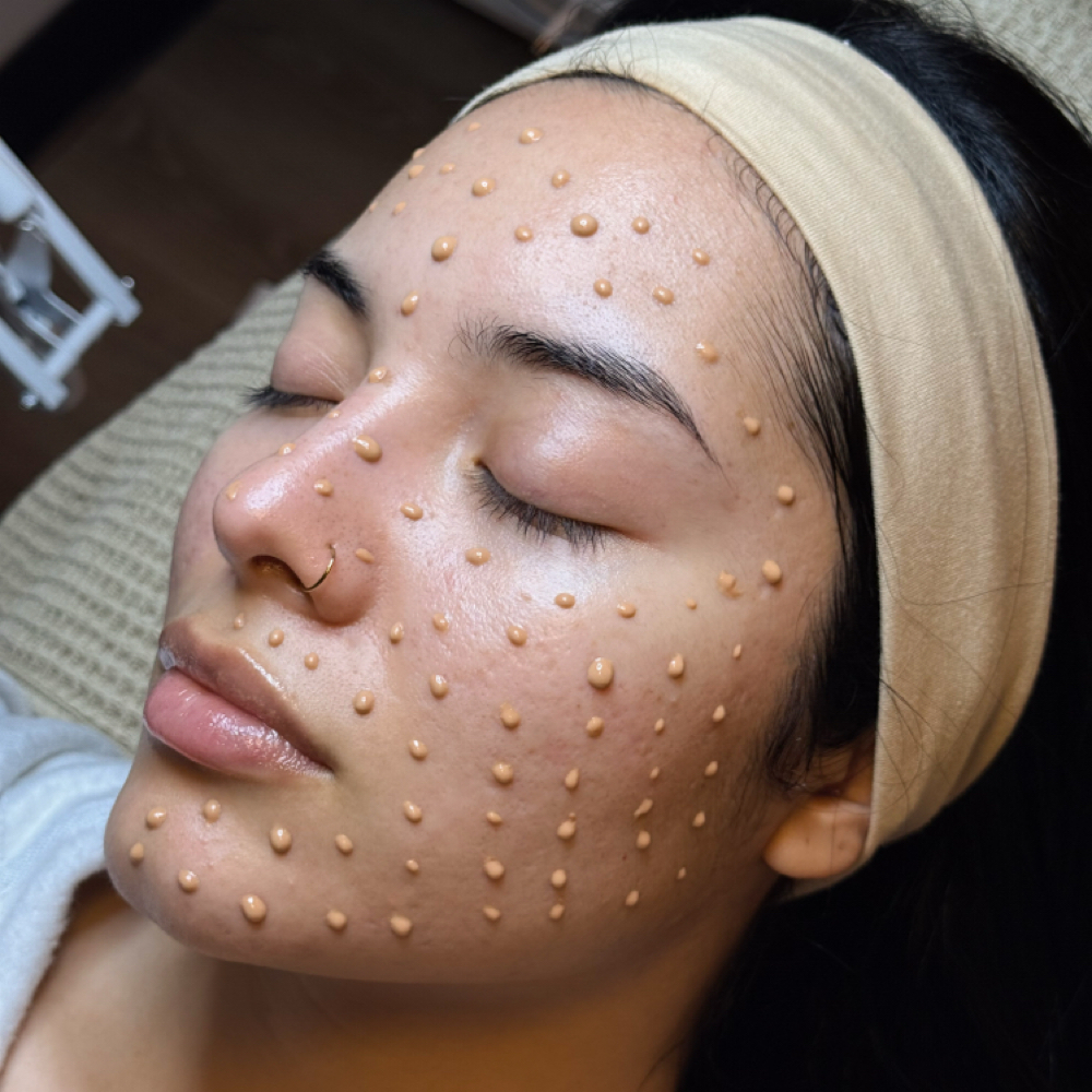 Acne Facial at Solo Skin Studio in Nashville, TN