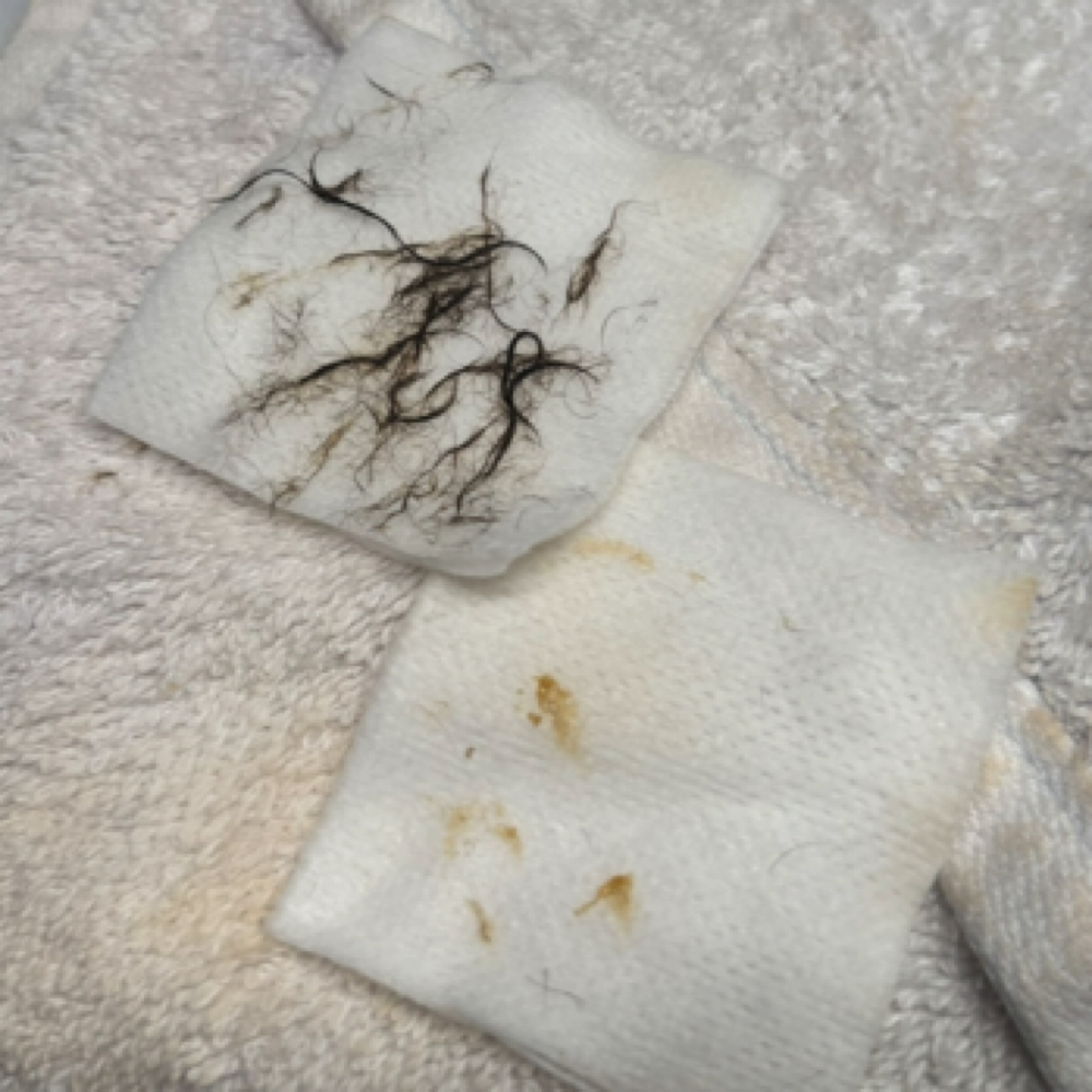 Dermaplaning + Extractions at Lins Esthetics in Gaithersburg, MD