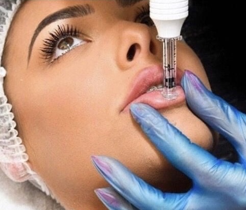 Needleless Lip Filler 1ML