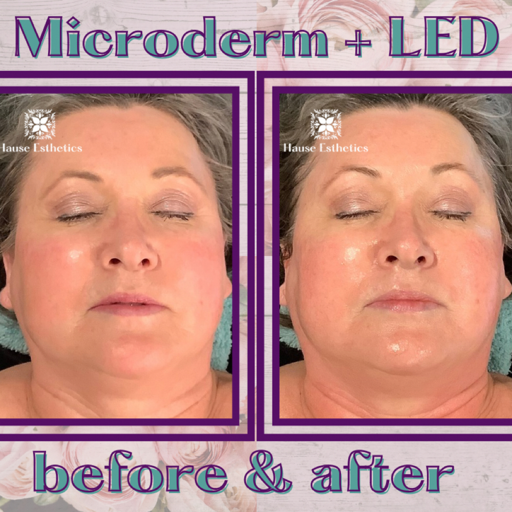 Mellow Microderm at Hause Esthetics in Morristown, TN