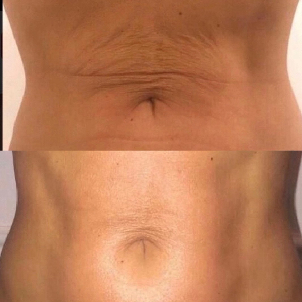 Eclipse Firma Skin Tightening