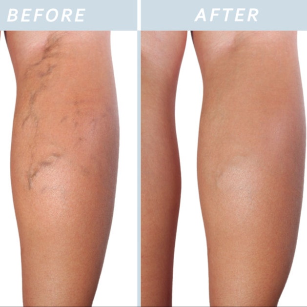 Laser Spider Vein Removal at Velvet Skin Aesthetics in Omak, WA
