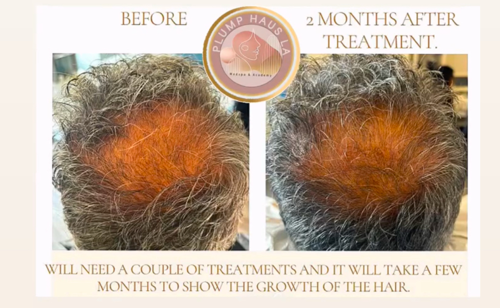 PRP HAIR RESTORATION Package