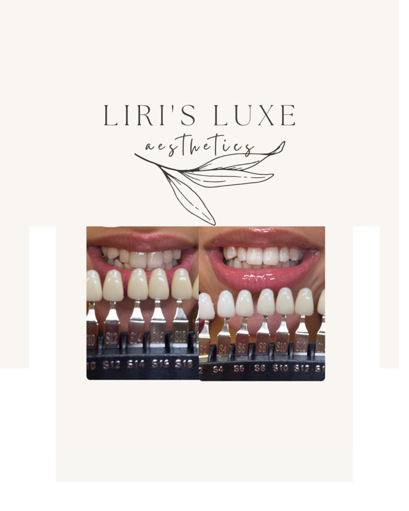 30 Min. Teeth Whitening Touchup