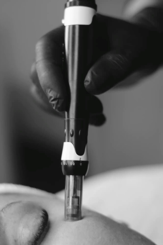 Microneedling⟢ at InjectorFaiiry in Greenville, TX