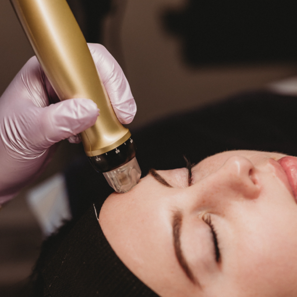 Aurora Signature Microneedling at Aurora Beauty in Normal, IL