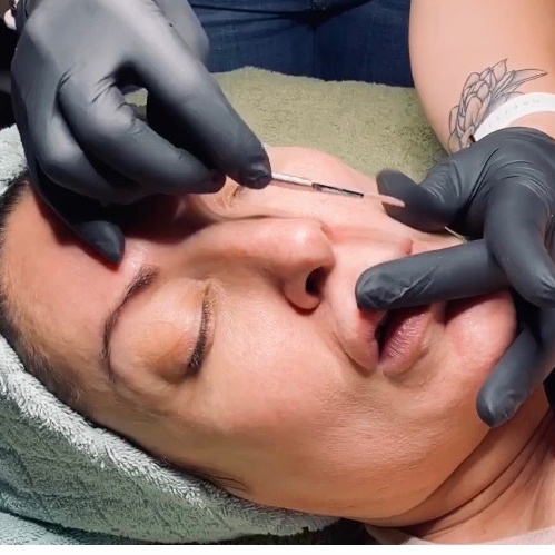 Dermaplaning at Three Little Birds Aesthetics in Centennial, CO