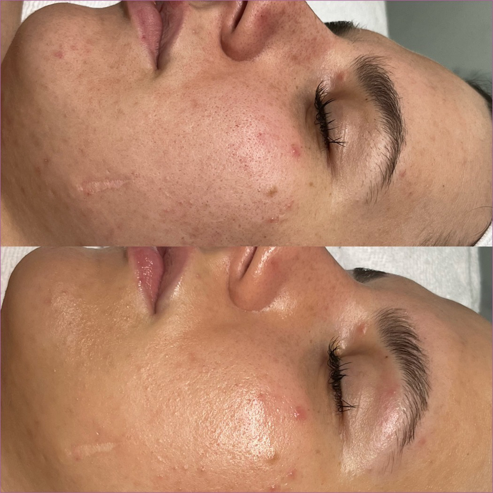 Acne Clear Facial